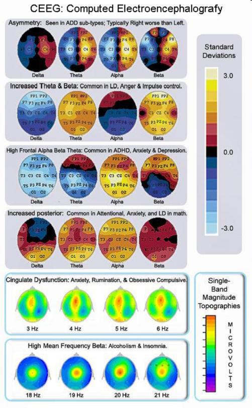 QEEG.jpg